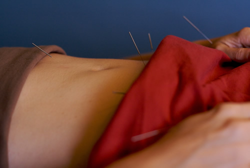 Lisa Pate Acupuncture